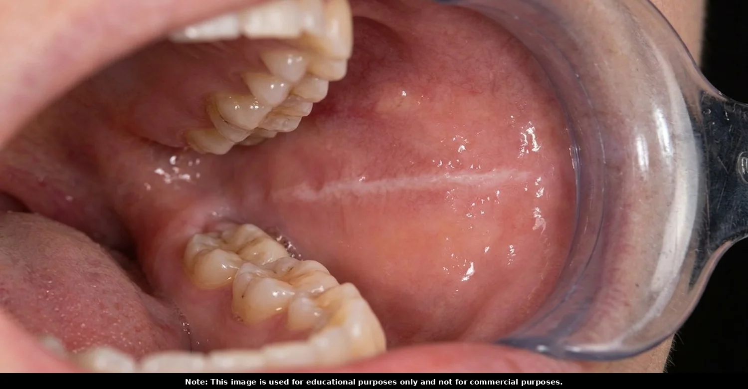Biting Cheek While Eating 2